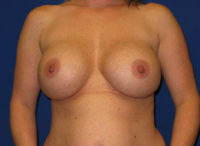 Breast Augmentation (Breast Implants)