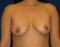 Breast Augmentation (Breast Implants)