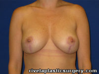 Breast Reduction Surgery