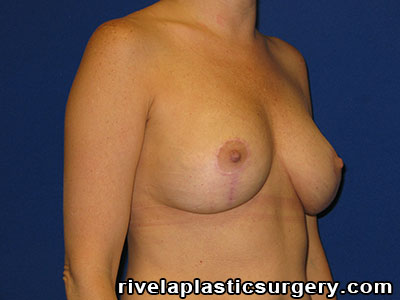 Breast Reduction Surgery