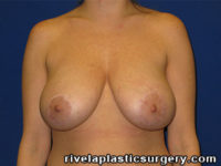 Breast Reduction Surgery