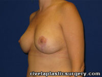 Breast Reduction Surgery