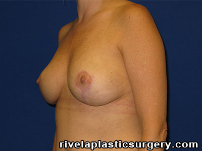 Breast Reduction Surgery