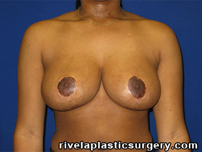 Breast Reduction Surgery