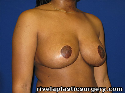 Breast Reduction Surgery