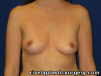 Breast Augmentation (Breast Implants)