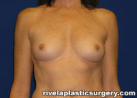 Breast Augmentation (Silicone Gel Implants)