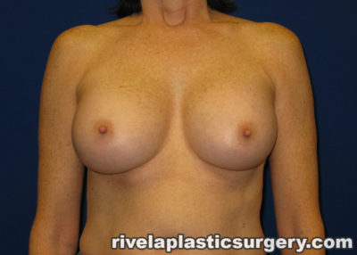 Breast Augmentation (Silicone Gel Implants)