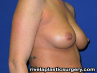 Breast Augmentation (Silicone Gel Implants)