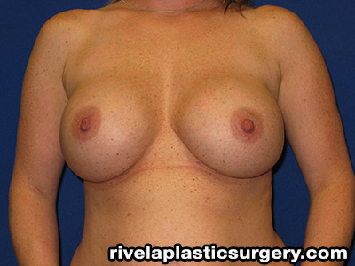Breast Augmentation (Silicone Gel Implants)