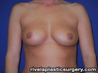 Breast Augmentation (Silicone Gel Implants)