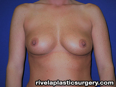 Breast Augmentation (Silicone Gel Implants)