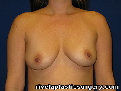 Breast Augmentation (Breast Implants)