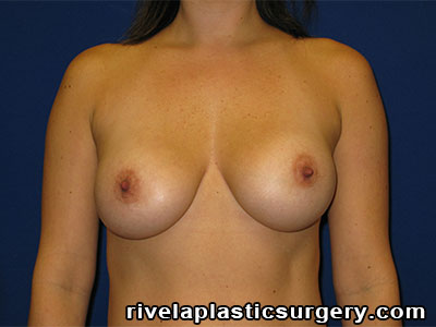 Breast Augmentation (Breast Implants)