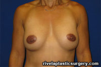 Breast Augmentation (Silicone Gel Implants)