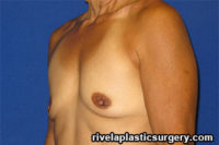 Breast Augmentation (Silicone Gel Implants)