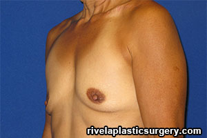 Aumento de Senos (Implantes de Gel de Silicona)