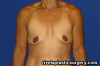 Breast Augmentation (Silicone Gel Implants)