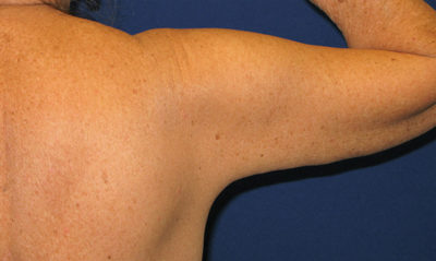 Braquioplastia