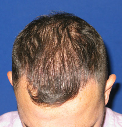 Hair Restoration Before & After Results