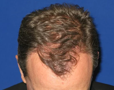 Restauracion de Cabello