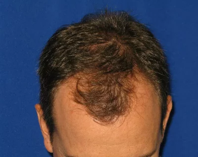 Restauracion de Cabello