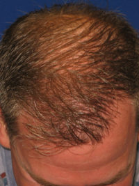 Hair Restoration