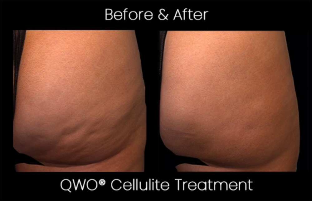 QWO before and after