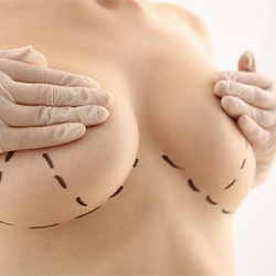How Long Does It Take Breast Lift Incisions To Heal?