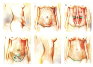 infografía del procedimiento de abdominoplastia