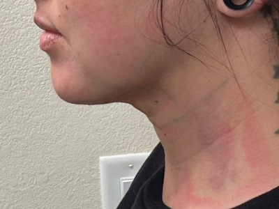 Chin SmartLipo